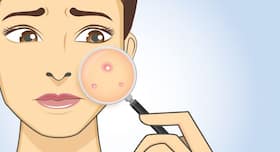 4 reasons you have random acne and skin breakouts