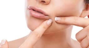 मुहांसों को आने से रोकने के ये रहे 4 एक्सपर्ट टिप्स