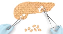 6 common symptoms of pancreatic cancer