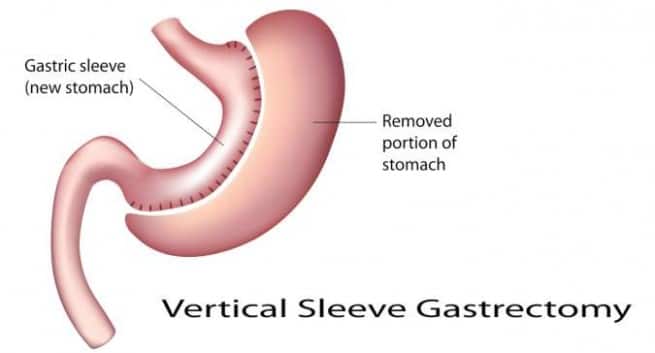 sleeve gastroectomy