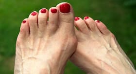 Foot deformity: Natural ways to treat bunions without surgery