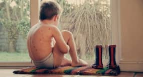 Chicken Pox होने पर न करें ये 5 ग़लतियां