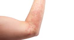 What You Need To Do To Avoid Eczema Flare Ups?