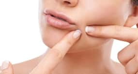 क्या  pimples को फोड़ने या दबाने से समस्या और बिगड़ जाती है?