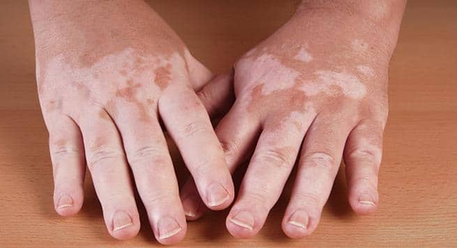 Vitiligo (Sumber: The Health Site)