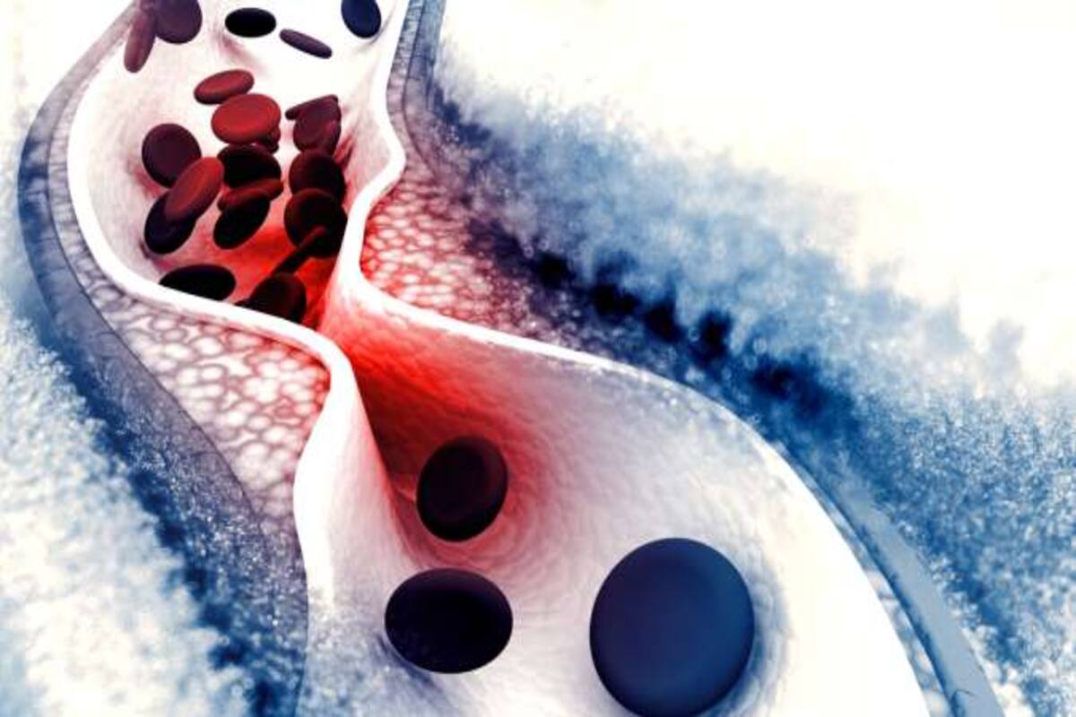 Should You Consider Chelation Therapy For Heart Disease Thehealthsite Com