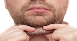 Get rid of double chin with Kybella (Deoxycholic Acid) injections for fat reduction from chin