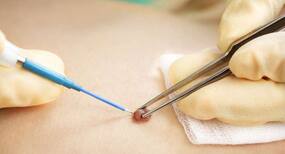 Mole reconstruction surgery -- what you need to know Mole reconstruction surgery -- what you need to know