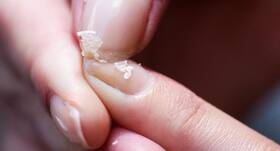 Nail splitting – Causes and remedies