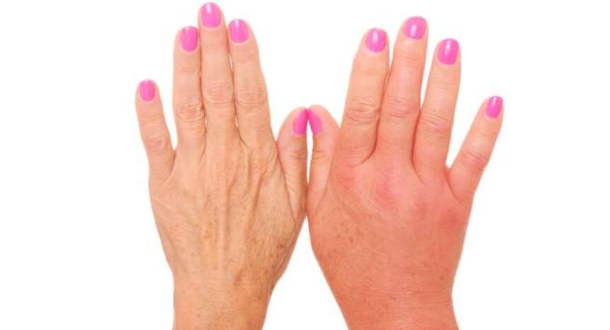 5 Home Remedies For Swollen Fingers