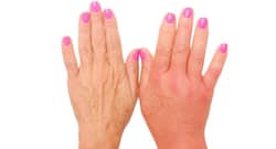 5 home remedies for swollen fingers