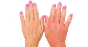 5 home remedies for swollen fingers 5 home remedies for swollen fingers