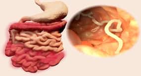 6 signs and symptoms of tapeworm infection