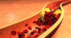 A 40-year-old man with 90% blockage undergoes life-saving Renal Angiography at Fortis