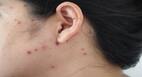 9 ways to keep your family healthy when someone suffers from chickenpox or other infectious conditions