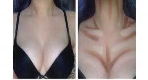 breast