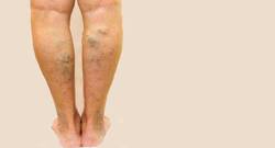 Varicose Veins: पैरों के दर्द को ना करें नज़रअंदाज़, हो सकती है वैरीकोज़ वेन्स की बीमारी