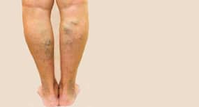 Varicose Veins: पैरों के दर्द को ना करें नज़रअंदाज़, हो सकती है वैरीकोज़ वेन्स की बीमारी