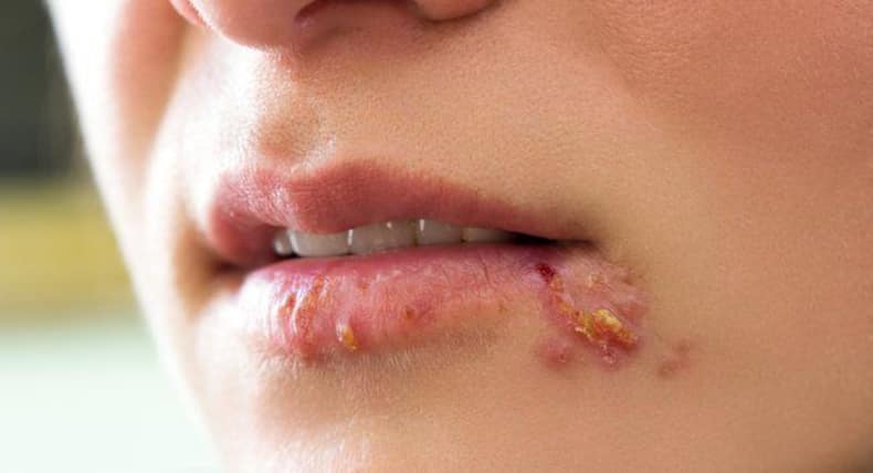 6 types of bumps you should NEVER squeeze or pop
