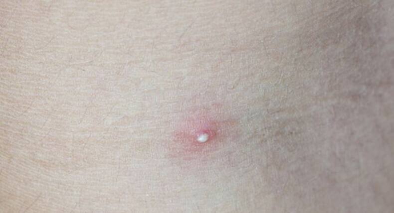 6 types of bumps you should NEVER squeeze or pop