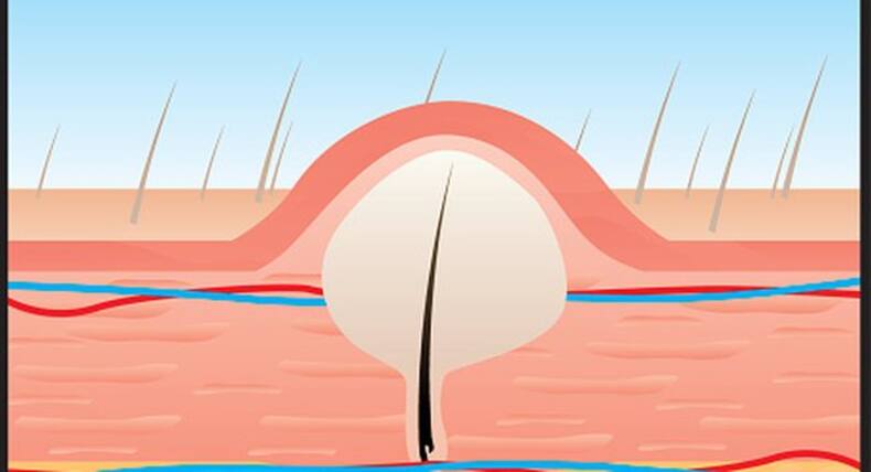 6 types of bumps you should NEVER squeeze or pop