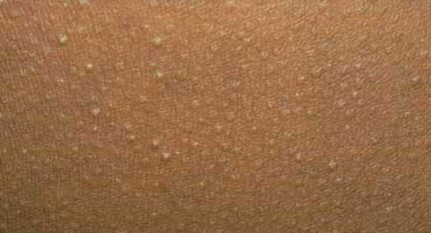 6 types of bumps you should NEVER squeeze or pop