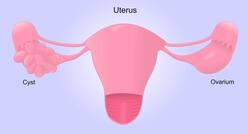 25% of Indian women of childbearing age suffer from PCOS: What can you do to alleviate the symptoms?