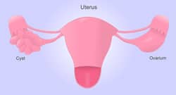 Dealing with PCOS - important diet and exercise tips