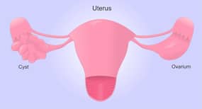 Dealing with PCOS - important diet and exercise tips