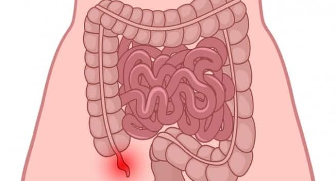 appendix appendectomy bursts healing query diet appendicitis boost pain tips thehealthsite side appendix1