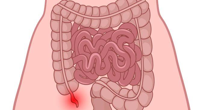 what causes your appendix to burst