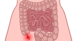 What do I do if my appendix bursts? (Query)