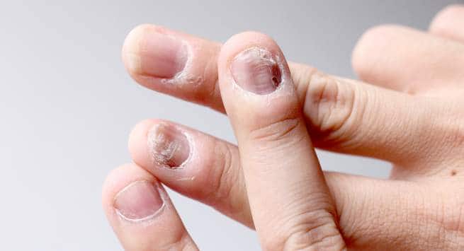 8 shocking things that happen when you bite your nails 