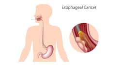 5 symptoms of esophageal cancer you should be aware of!