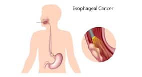 All you need to know about esophageal cancer All you need to know about esophageal cancer