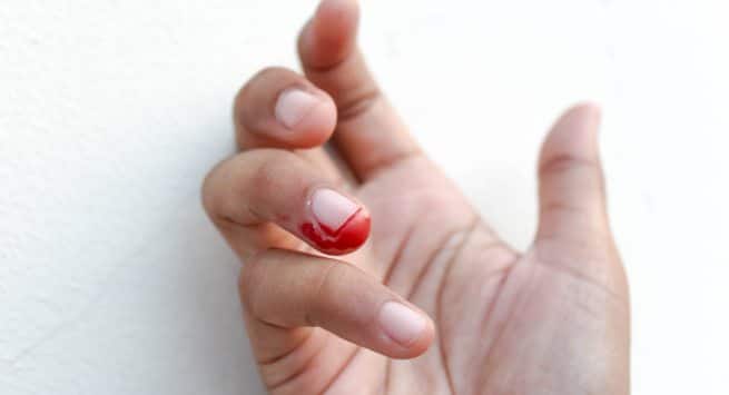 Man Nearly Died of Sepsis Reportedly Caused by Nail Biting | Teen Vogue