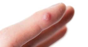 Treatment for warts: Follow these 4 tips Treatment for warts: Follow these 4 tips
