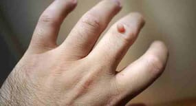 How to use apple cider vinegar to treat warts