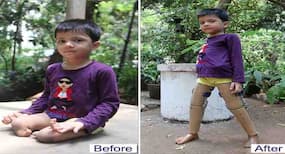 Abdul Khan was born without legs but can now walk and jump with Jaipur foot!