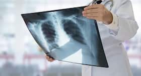 Are you at Tuberculosis (TB) risk? A new blood test could predict