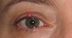 Stye or eye pimple से बचने के 11 आसान तरीके