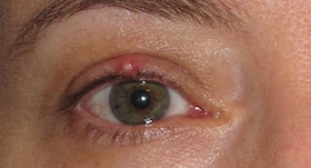 Stye or eye pimple से बचने के 11 आसान तरीके Stye or eye pimple से बचने के 11 आसान तरीके