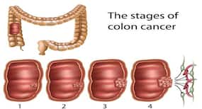 Triclosan tied to colon cancer