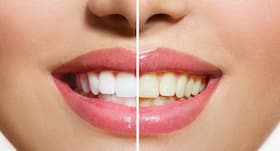 Dental veneers क्या है और इसकी जरूरत कब होती है?