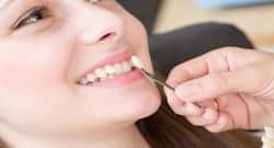 What are teeth veneers or dental veneers?