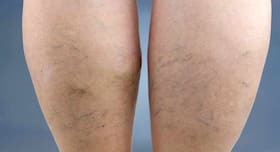 Fortis Mohali introduces Glue Closure Technique to treat varicose veins