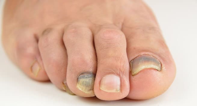 What Makes Toenails Dark