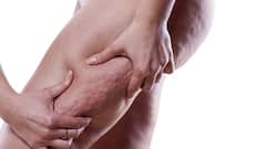 6 things that are giving you ugly cellulite!