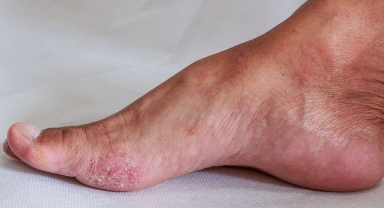 6 reasons your feet are peeling (even in summer!)