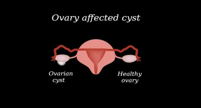 Uterine Fibroids Polyps And Cysts What Is The Difference 